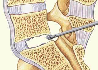 Transforaminal Lumbar Interbody Fusion (TLIF)