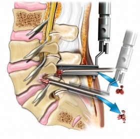 Minimally Invasive Spine Procedure