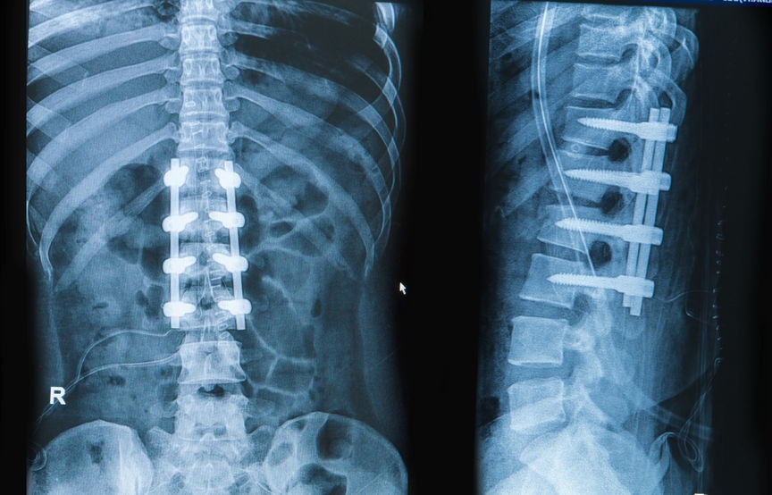 Spine Surgery