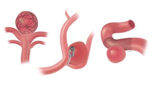 Read more about the article Aneurysm