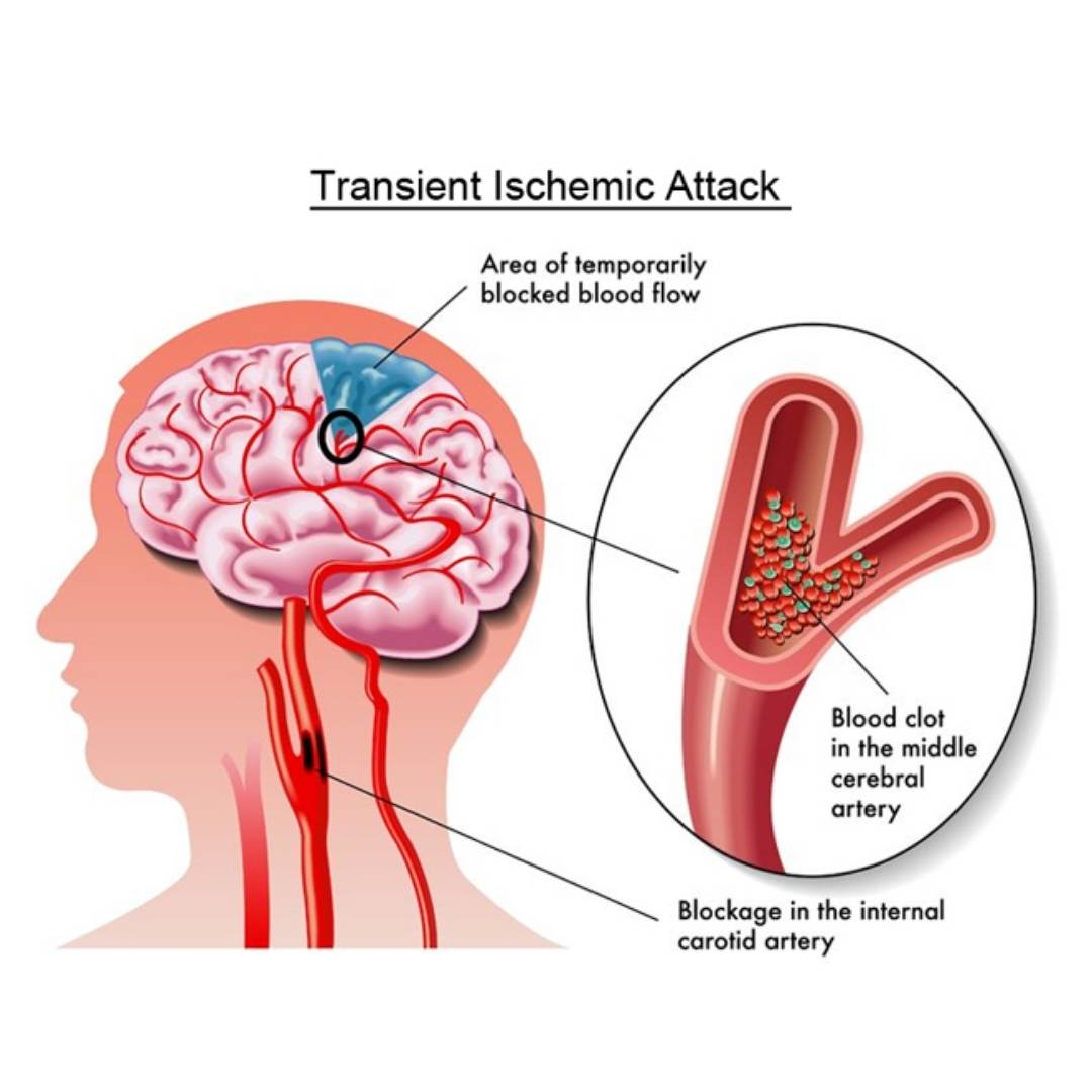 Ischemic attack